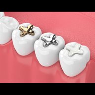 セラミック問題！歯においくらほどかけられますか？？